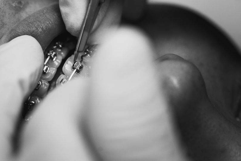 Appareil multi-attache en orthodontie
